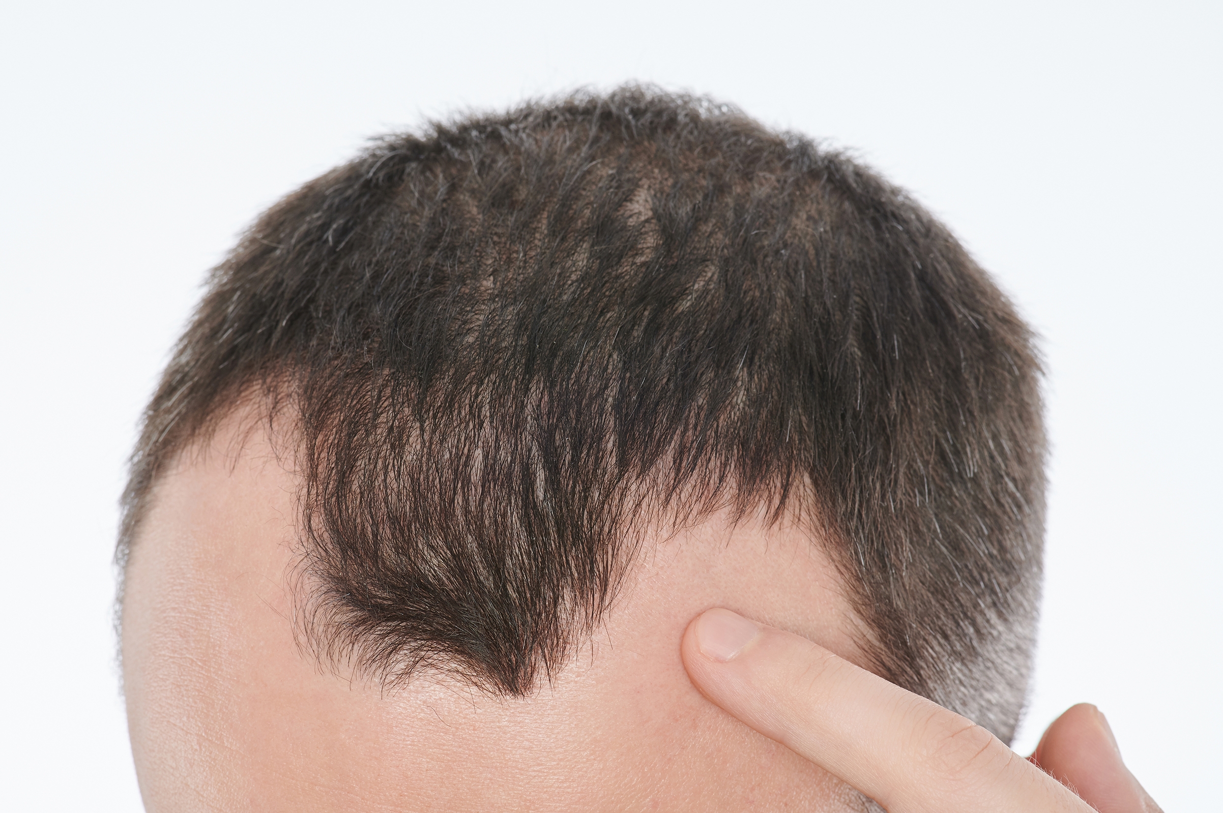 Could nutrient deficiencies lead to hair loss? - Abundance and Health